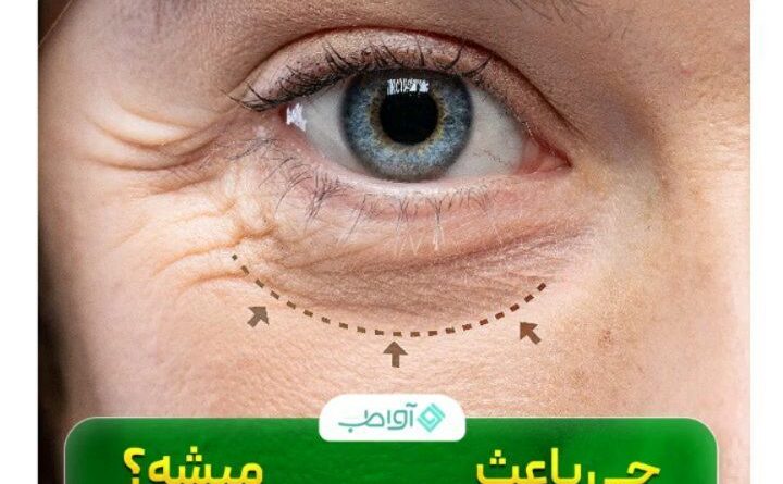 چه چیزهایی باعث چروک دور چشم می شوند؟