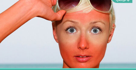 10 نکته مهم درمان آفتاب سوختگی