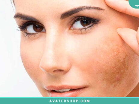 لک های تیره پوست چیه و چجوری میشه درمانشون کرد؟