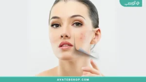 رهایی از جوش استرسی و عصبی