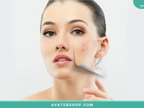 رهایی از جوش استرسی و عصبی