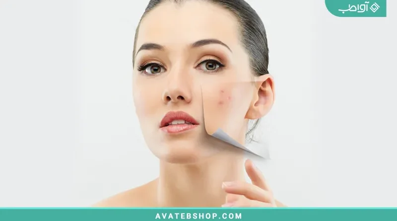 رهایی از جوش استرسی و عصبی