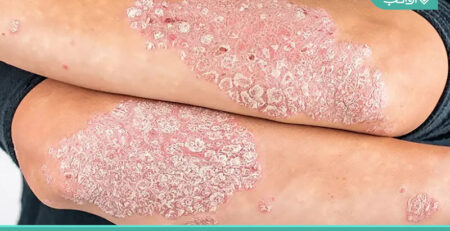 پسوریازیس Psoriasis