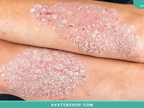 پسوریازیس Psoriasis