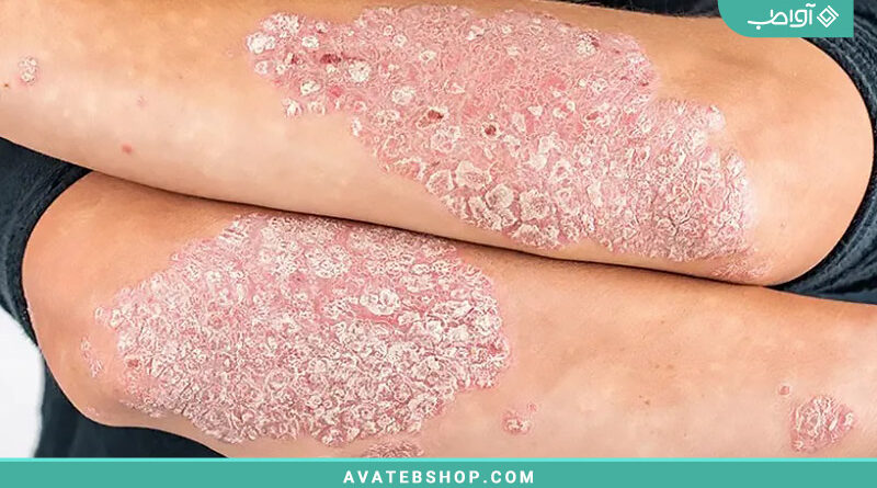 پسوریازیس Psoriasis