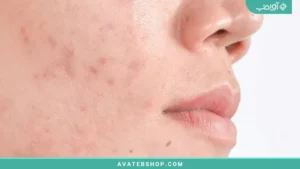 هایپرپیگمنتیشن بعد از التهاب