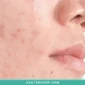 هایپرپیگمنتیشن بعد از التهاب